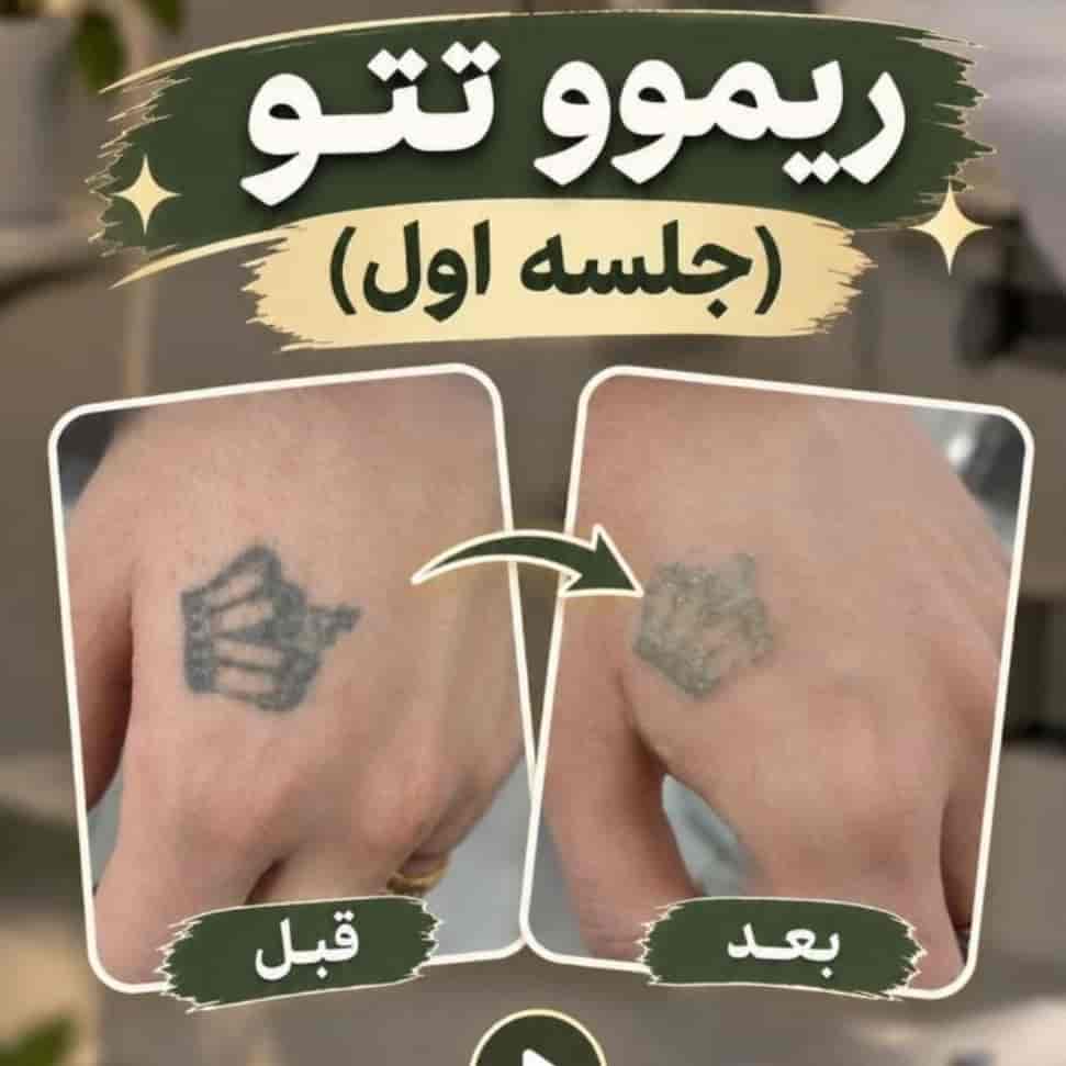 ریموو تتو در گرگان
