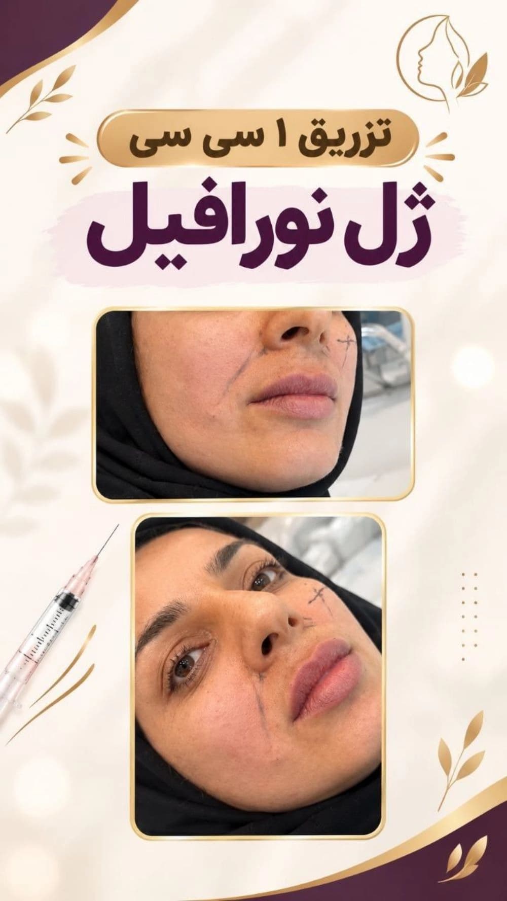 تزریق ژل لب نورافیل