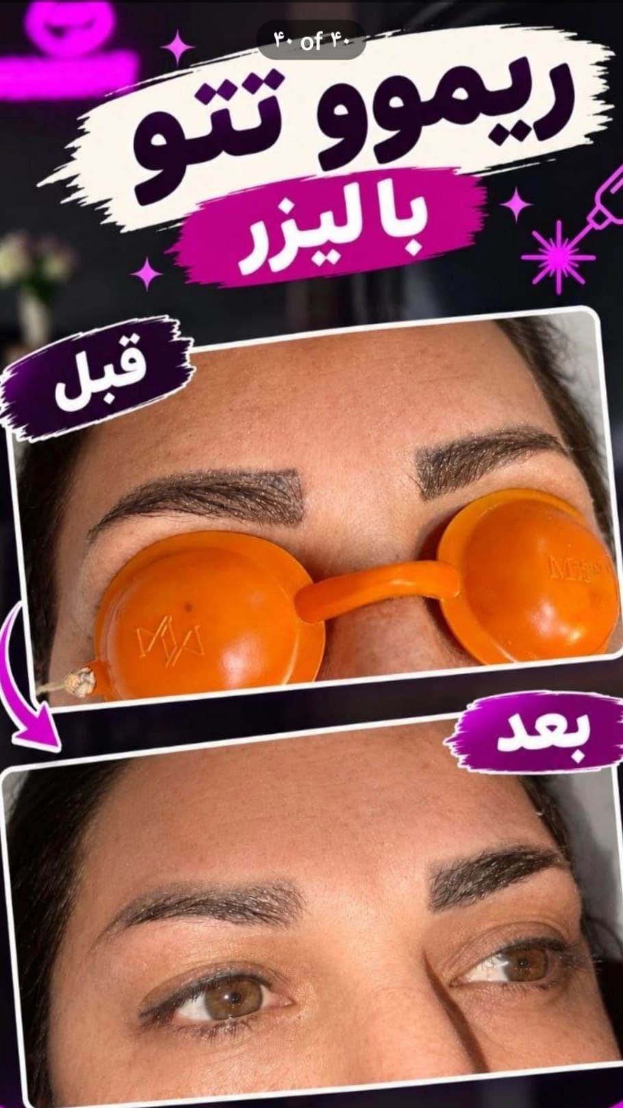 ریموو تتو ابرو